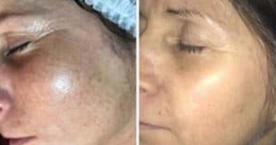 Comparaison peau avant et après